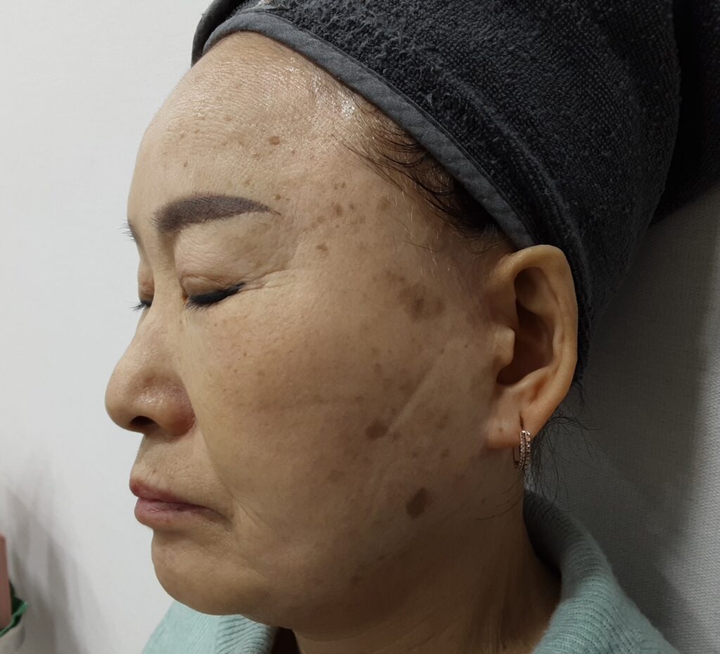 흑자치료 피코MLA 레이저 효과는 무엇일까?
