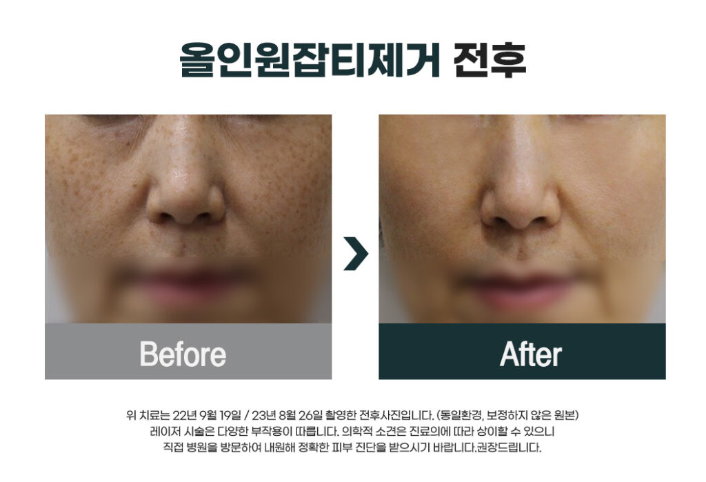 레이저토닝 10회 이상 해야 되는 이유는 무엇일까? 3