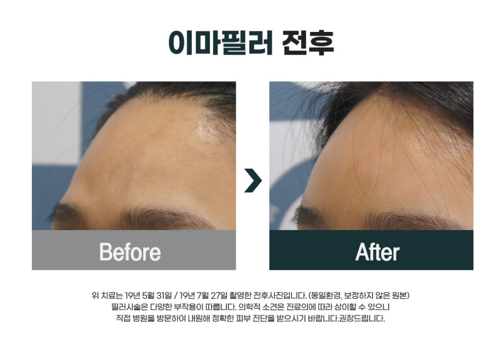 이마필러 부작용, 피하는 방법은 무엇일까? 3