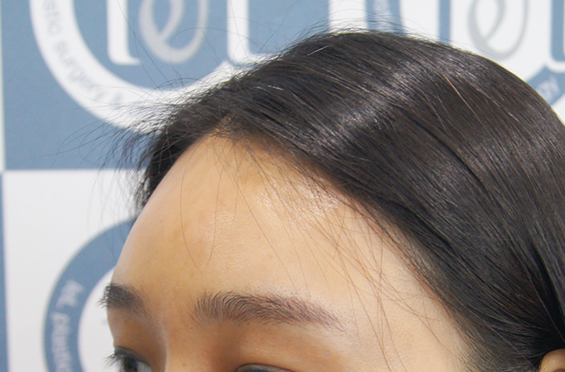이마필러 부작용, 피하는 방법은 무엇일까?