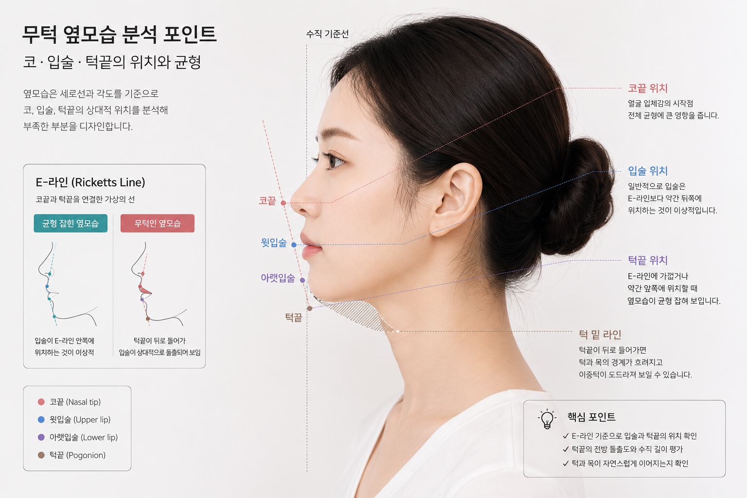 무턱 옆모습에서 코와 입술 및 턱끝의 위치를 분석한 의료 일러스트