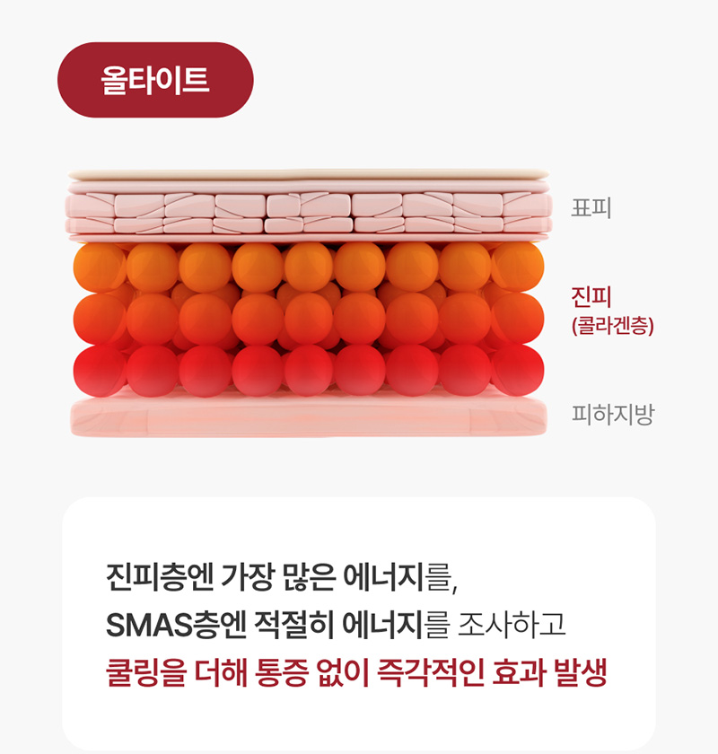 올타이트 유지기간, 리프팅 효과는 얼마나 지속될까? 2
