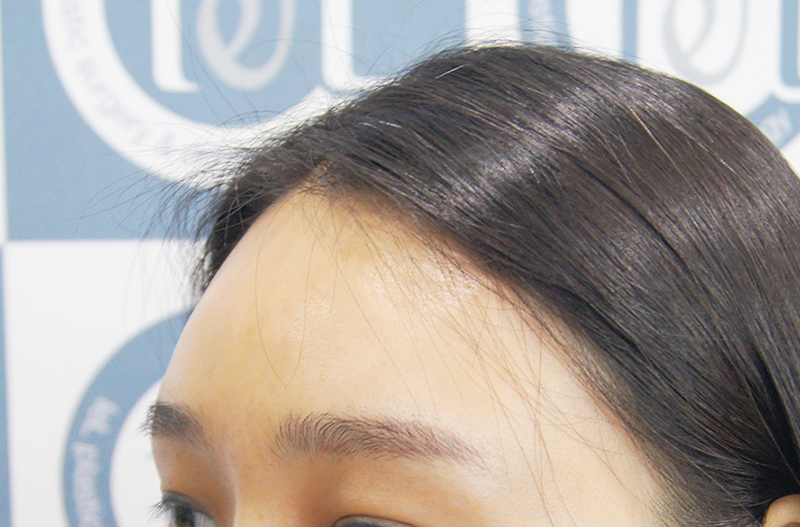 강남 이마필러 잘하는곳, 어떤 기준으로 찾아야 할까? 1